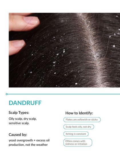 Is it dandruff or just a dry winter scalp? This infographic explains the key characteristics of dandruff, which is caused by yeast overgrowth and results in yellowish, sticky flakes.