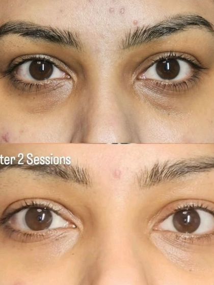 This client saw a dramatic improvement after two sessions, showcasing how the treatment can be customized for more persistent dark circles.