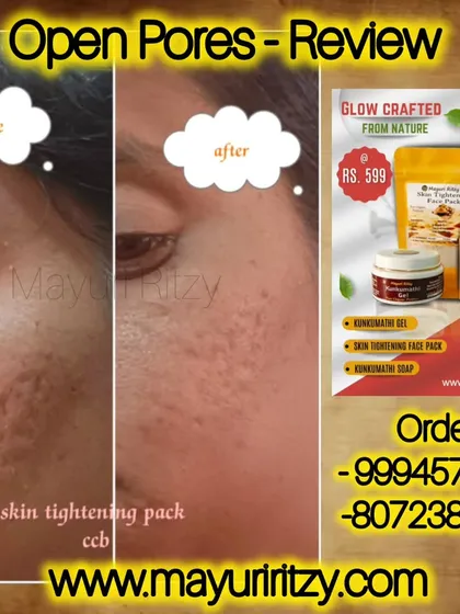 Many of you ask me about open pores, and here is the result you can expect. This is a real customer's 'before and after' photo after using my skin tightening pack. You can see how the pores have visibly reduced, making the skin look smoother and clearer.