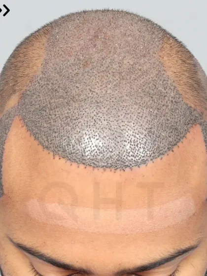 A Norwood Grade 6 transformation in progress. 5900 grafts were placed to recreate the hairline, frontal part, mid-scalp, crown, and temples.