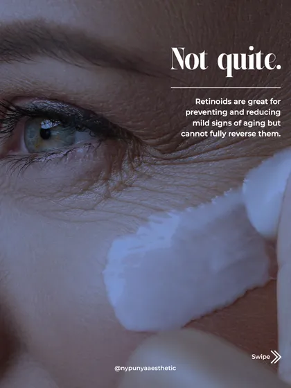 The truth is, retinoids are great for preventing and reducing mild signs of aging, but they cannot completely reverse them. They work on the top layer of skin, while deeper aging requires clinical treatments.