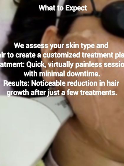 This image explains what you can expect from our facial laser hair removal. We start with a personalized assessment of your skin and hair, followed by a quick, comfortable session that leads to noticeable hair reduction.