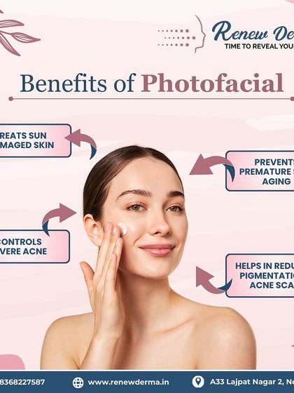 This graphic outlines the key benefits of a Photofacial. This light-based therapy is excellent for treating sun-damaged skin, controlling severe acne, preventing premature aging, and reducing pigmentation and acne scars for a clearer complexion.