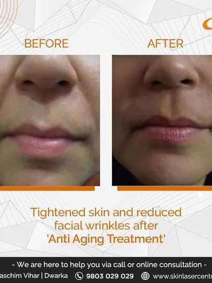 This result was achieved using cosmetic fillers to address facial wrinkles and lost volume around the mouth. I carefully inject the filler to soften these lines, restoring a smoother and more youthful appearance. My goal is always a natural, refreshed look.