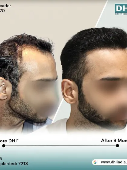 Another side-profile view of the 9-month transformation. This angle highlights the seamless integration of the new hair, creating a natural and aesthetically pleasing outcome.