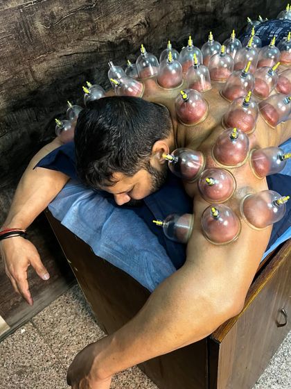 Athlete Narender Yadav undergoing a full-back cupping session.