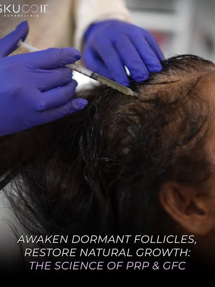 Here, we are performing a PRP & GFC treatment, injecting a concentration of the client's own growth factors directly into the scalp. This procedure is designed to restore natural growth by stimulating inactive follicles.
