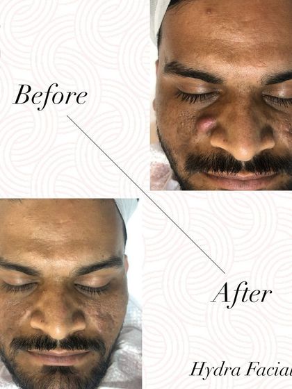 HydraFacial is for men too. This before and after demonstrates how the treatment balances oil production and prevents breakouts on thicker male skin.
