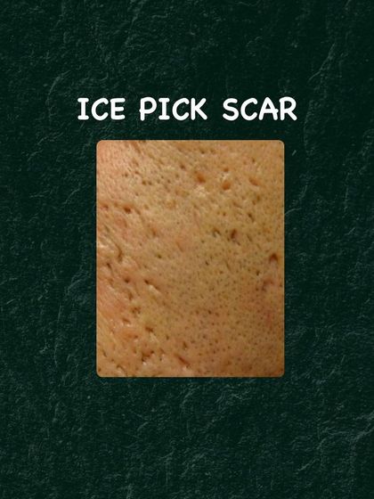 This image shows a typical presentation of ice pick scars. Their depth requires specialized in-clinic procedures for visible improvement.