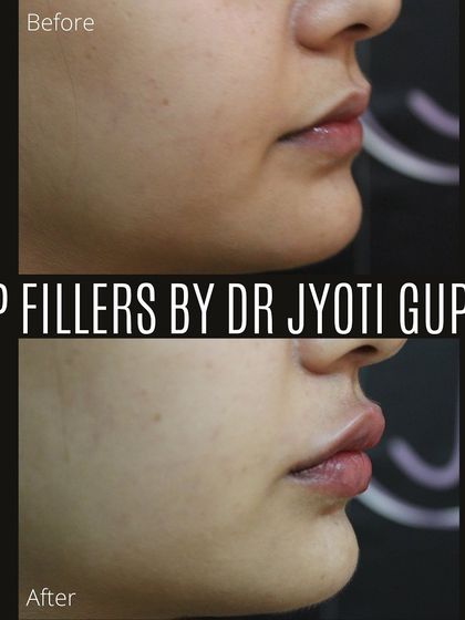 From the side profile, you can see how lip fillers not only add volume but also improve the projection and shape of the lips. This creates a better balance with the nose and chin for overall facial harmony.