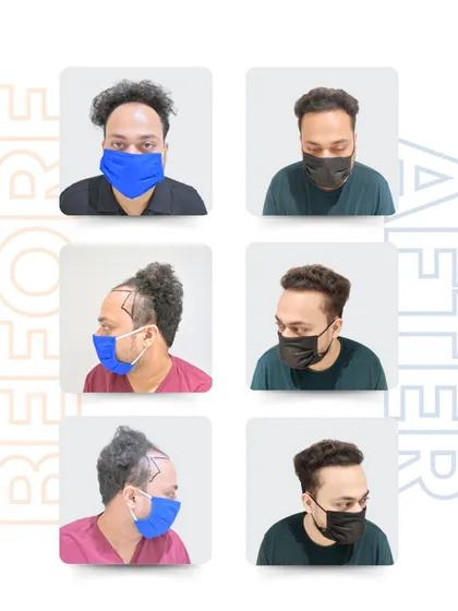 Here is Anurag’s transformation from all angles. The 3,000 grafts placed with the Sapphire Blade technique resulted in a remarkably natural and dense hairline, showcasing the precision of this advanced method.