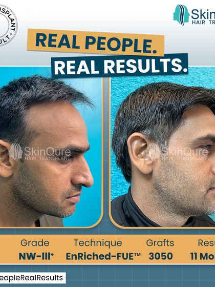At 39 years old, this patient had Norwood Grade III hair loss. With 3050 grafts using the EnRiched-FUE technique, we restored his hairline and added density. The 11-month result shows a mature, natural hairline that is both age-appropriate and full.