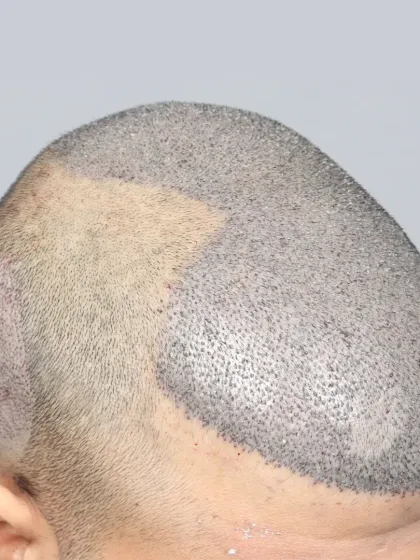 The result of implanting 5900 grafts for a Diffuse Grade 6 patient, showing the density and coverage achieved.