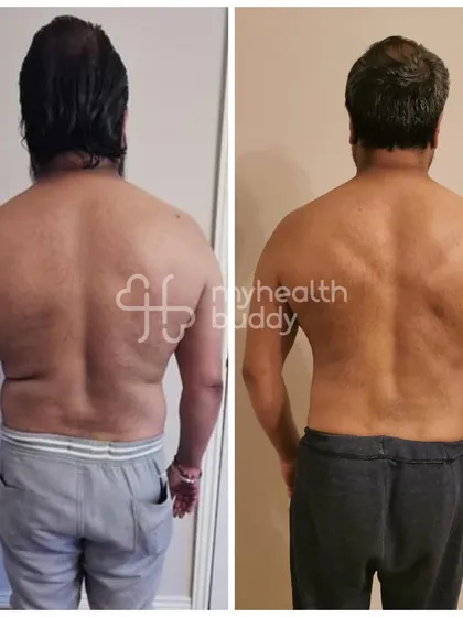 Vikas lost 8 kgs in 3 months while managing Type 2 Diabetes. This back view shows a significant improvement in his body composition and muscle definition.