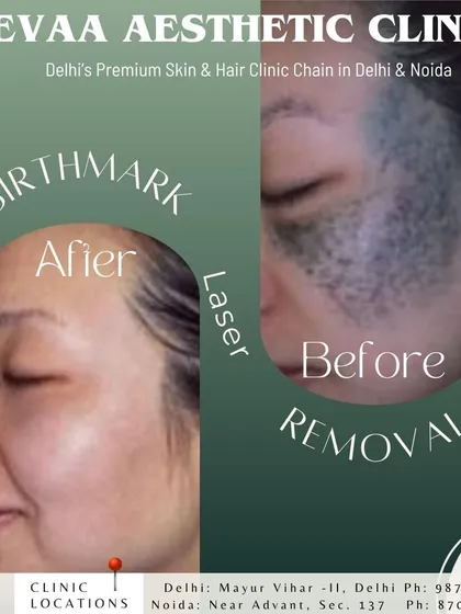 A powerful before and after of a laser birthmark removal procedure. Our specialized lasers target and break down pigmented lesions, significantly lightening the birthmark and evening out the skin tone for a renewed appearance.