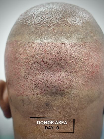 Skinmatics - Hair Restoration FUE Hair Transplant: Results & Transformations photo 11