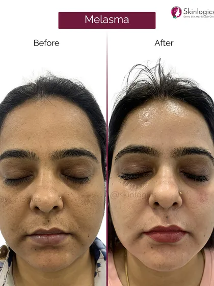 A front-facing view of a patient's successful melasma treatment. The 'after' image shows a dramatic reduction in the patchy, dark pigmentation on the cheeks and nose, resulting in a much clearer complexion.