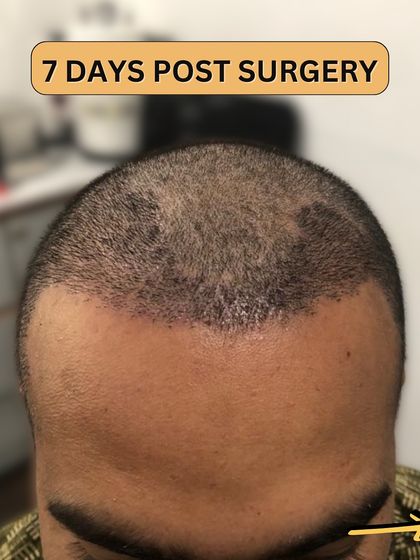 7 days post-surgery. The initial healing is progressing well, and the short, transplanted hairs are settling in. Scabbing is minimal and starting to clear.