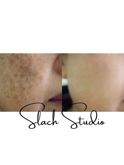 A close-up view of pigmentation being effectively cleared from the cheek area, showcasing the precision of the treatment.