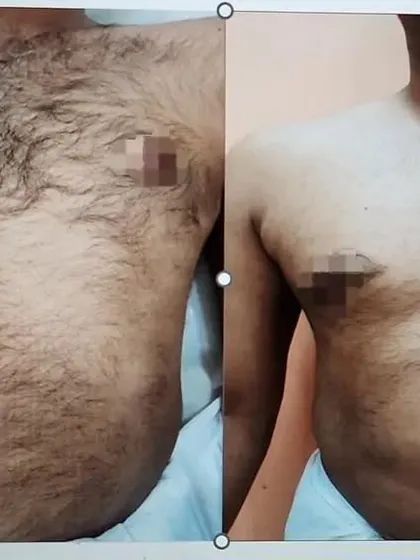 This before and after image shows the results of laser hair reduction on the chest for a male patient after just a few sessions. My advanced dual-wavelength laser offers effective and comfortable hair reduction for various skin and hair types, for both men and women.