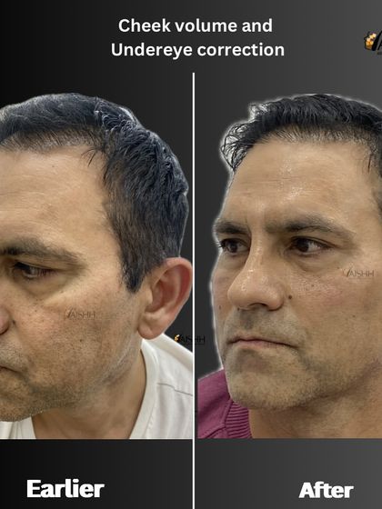 This patient's treatment plan included 3ml of hyaluronic acid filler to correct flat cheeks and deep, hollow under-eyes, resulting in a less tired and more vibrant look.