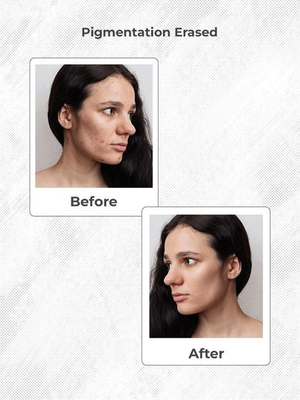 This before-and-after photo shows a successful pigmentation treatment. We erased the uneven patches and restored a clear, uniform skin tone for this patient, giving her a happy ending to her skin story.
