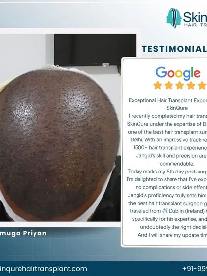 Shanmuga Priyan traveled from Dublin, Ireland, specifically for my expertise. He shares his 5-day post-surgery experience, noting no complications and praising my skill and precision. His trust is a testament to our global reputation.