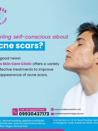 Feeling self-conscious about acne scars is a common concern we address. We offer a variety of effective treatments, from microneedling to laser therapy, designed to improve the appearance of acne scars and give you smoother, clearer skin.
