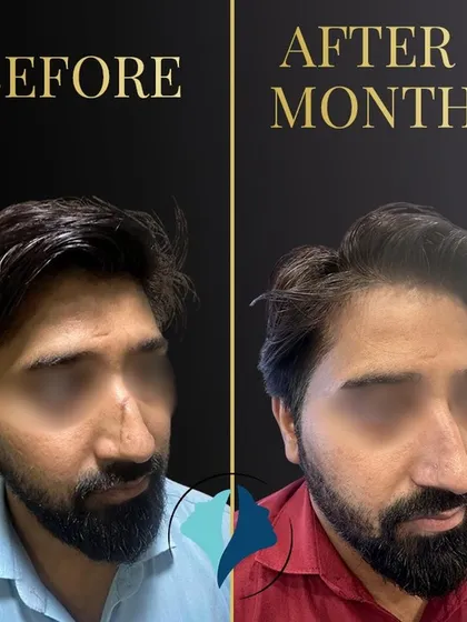 This patient came to me with a prominent scar on his nose from a previous injury. Through a surgical scar revision procedure, we were able to significantly reduce its visibility. This photo shows the result after six months of healing, demonstrating a much smoother and more natural appearance.