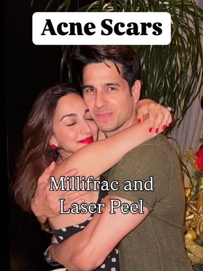 For acne scars, combining treatments like Millifrac and a Laser Peel can be a powerful duo, addressing both texture and pigmentation for comprehensive results.