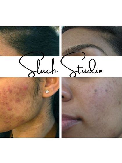 This image shows the successful treatment of both active acne and the residual red marks, resulting in clearer, healthier skin.
