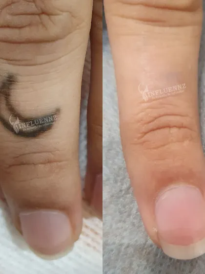 A complete and clear result. This before and after shows the full removal of a dark ink tattoo from a finger after completing the required sessions. The skin is left clear and undamaged, showing the effectiveness of a properly administered Pico Laser treatment plan.