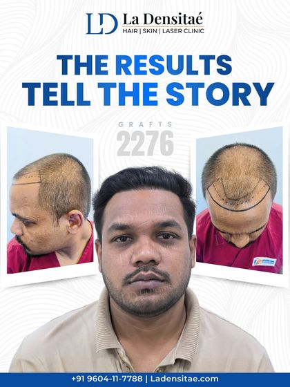 Just months ago, hair loss was a daily concern for Mr. Gautam Kumar. Today, after a transplant of 2,276 grafts, he has a full, natural-looking hairline. This is what happens when expert planning and precision come together.