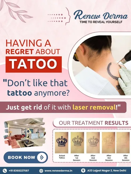 This shows how laser tattoo removal works over time. It's not a one-time fix but a journey. Each session breaks down more ink, and your skin needs time to heal and clear the pigment in between visits.