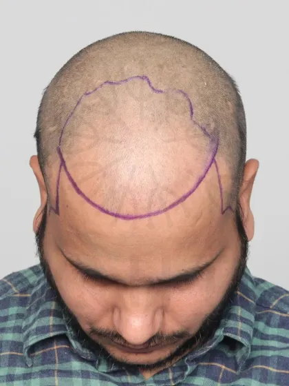 This shows the crucial first step: hairline design. We mark the area precisely to ensure the final result perfectly frames the face.