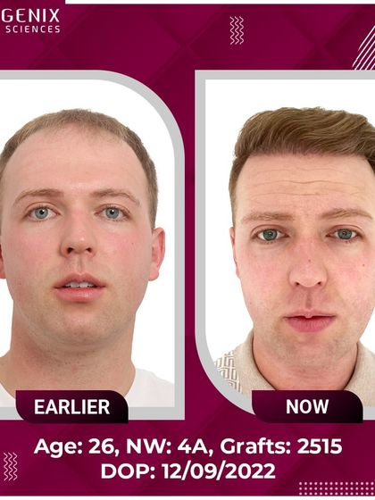 A complete before-and-after set of a 26-year-old patient from the UK, showcasing a restored hairline and youthful appearance.