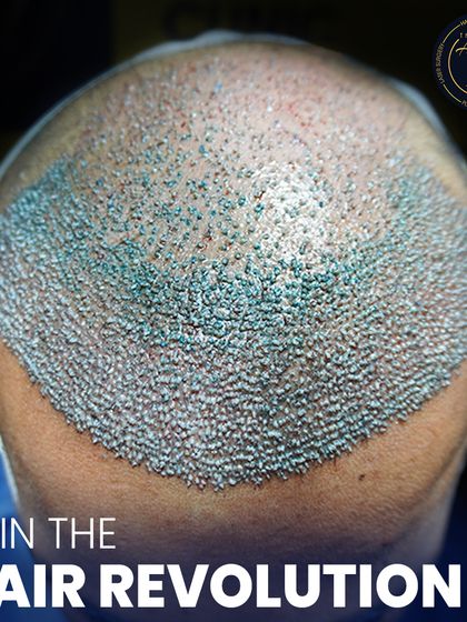 A close-up showcasing the individual grafts. Each dot represents a follicular unit, which may contain one to four hairs. This precision allows us to build a completely customized and dense hairline.
