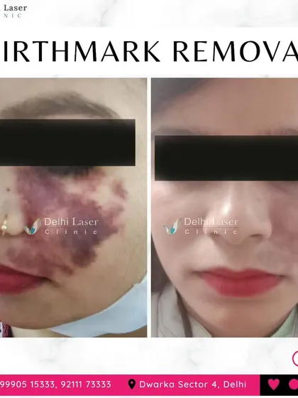 This before and after image shows the significant lightening of a facial birthmark after laser treatment. Our non-invasive laser procedures can effectively reduce the appearance of vascular and pigmented birthmarks with minimal downtime.