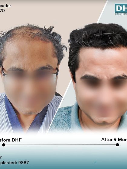 A frontal before and after of the 47-year-old client. The restored hairline and fuller look have given him a renewed sense of confidence just 9 months after his hair transplant.