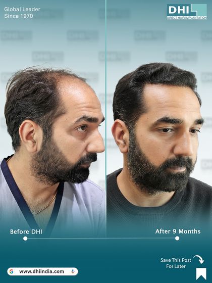 A side-profile comparison 9 months after a DHI hair transplant. This image clearly shows the restored hairline and the impressive density achieved, resulting in a more youthful and confident appearance.