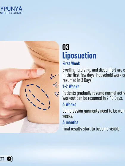 A look at the liposuction recovery process. Household work can be resumed in 3 days, with final results starting to become visible around the 6-month mark.