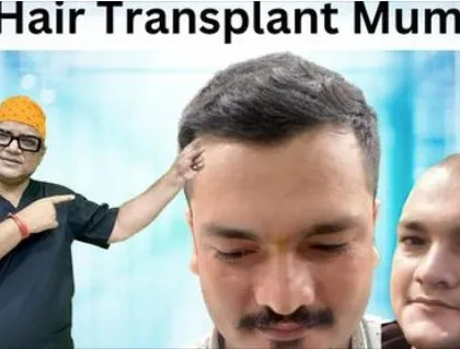 A promotional image for our hair transplant services in Mumbai, featuring myself. We aim to provide the best and most affordable hair transplant solutions in the city.