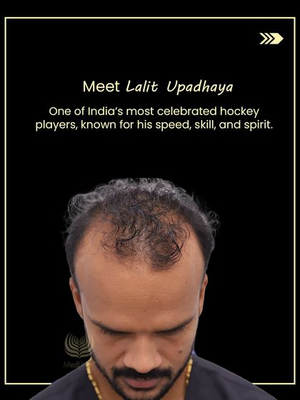 This is Lalit Upadhyay, one of India's most celebrated hockey players, before his hair transplant, dealing with Grade 5 hair loss.