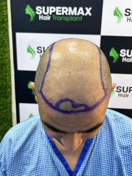 After shaving, the transplant area is clearly marked. This planning is crucial for a natural-looking hairline and density.