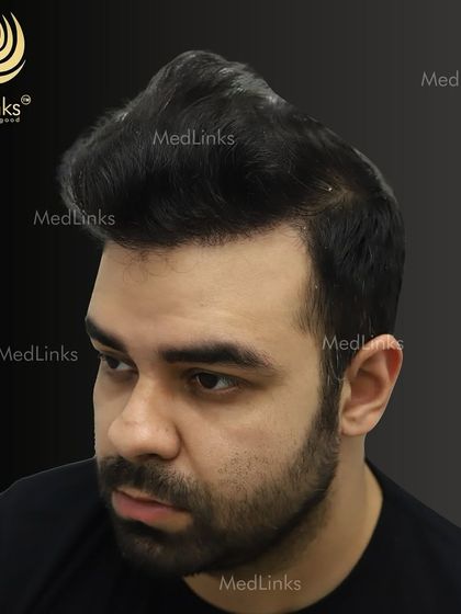 The final result from the side, showing a natural and dense hairline.