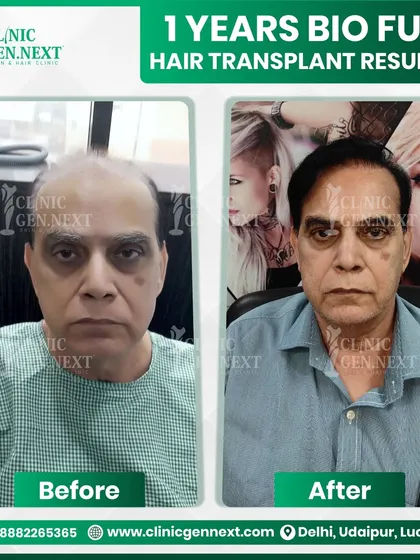 It is never too late to regain your confidence. This 72-year-old patient came to me with advanced hair loss, and with a BIO-FUE procedure, we achieved this natural and dense result in just one year.