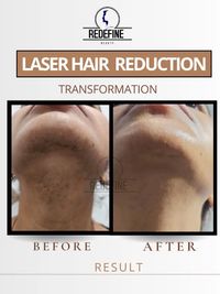 Laser Hair Removal