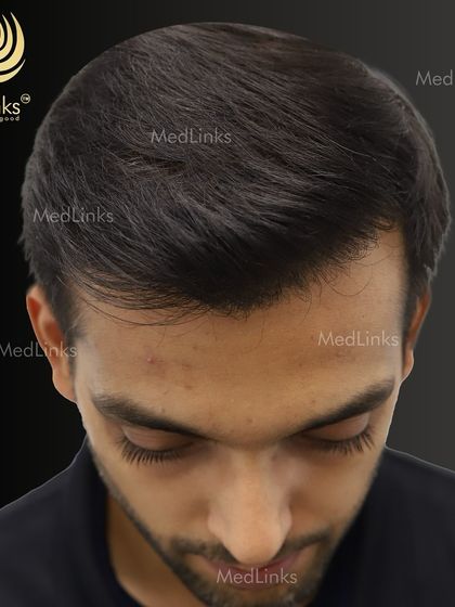 A view from the top after the hair transplant, showing the impressive density and coverage achieved. The new hair blends perfectly with the existing hair.