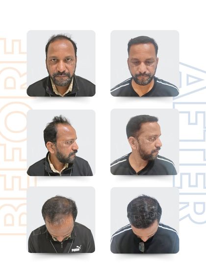 This multi-angle view of Mr. Liyakat Hussain’s hair restoration shows the comprehensive coverage we achieved. From the front to the crown, every area was carefully addressed to ensure a balanced and natural-looking outcome.