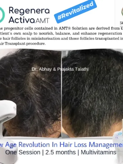 This patient saw a revitalized scalp and thicker hair just 2.5 months after a single session of Regenera Activa, supported by multivitamins. Our goal is to restore not just your hair, but your confidence too.